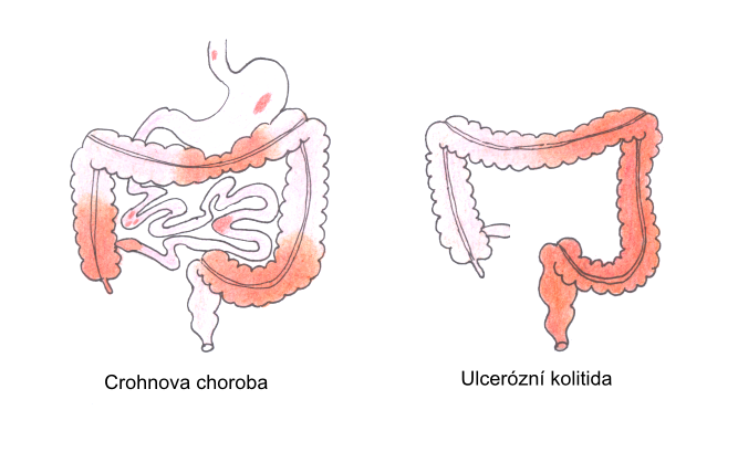 nonspecific-intestinal-inflammations-wikilectures