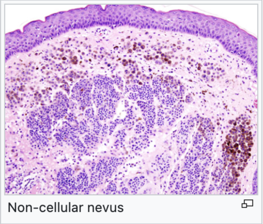 melanocytic-tumors-wikilectures