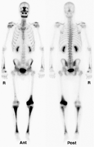 Scintigraphy - WikiLectures