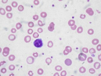 Anemia from reduced erythrocyte production - WikiLectures