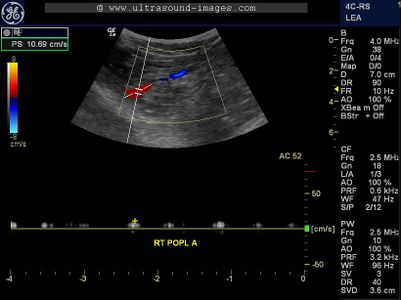 Doppler echocardiography - Wikipedia