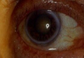 Corneal deposits - WikiLectures