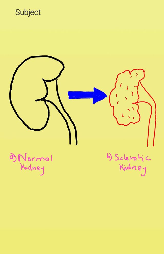 chronic-renal-failure-wikilectures