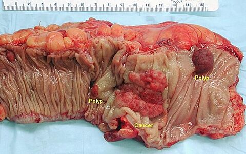 Polyposis colorectal cancer (lesion in the middle, lesions on the right and left are polyps).
