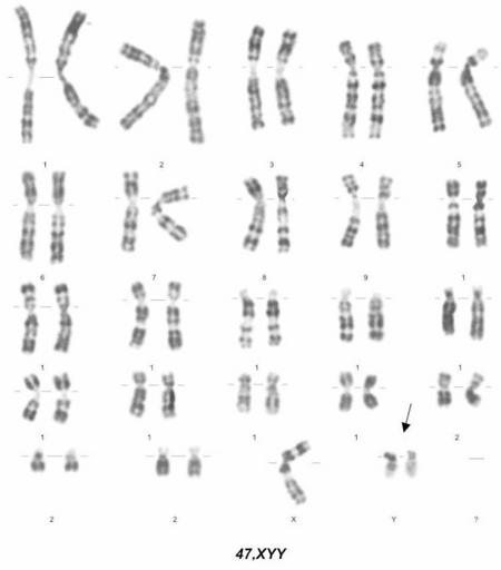 Syndrome 47, XXY - WikiLectures