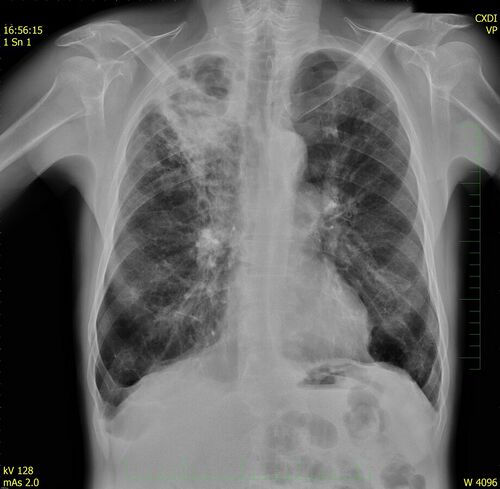 Tuberculosis (pathology) - WikiLectures