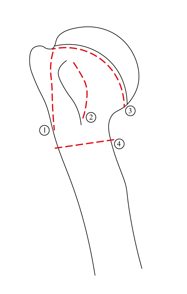 humeral-head-fractures-wikilectures