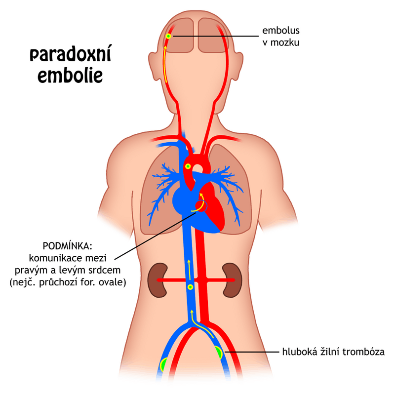 Paradoxical embolism - WikiLectures