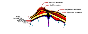 Scalp hematomas cesky.png