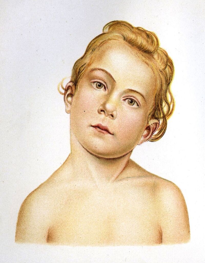 Congenita muscularis torticollis - WikiLectures